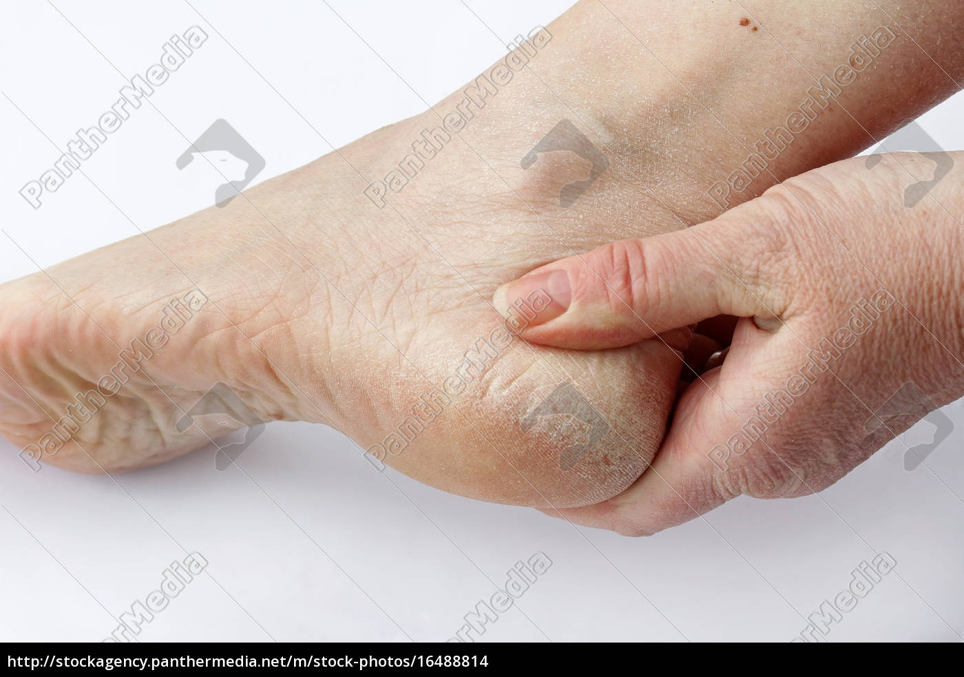 kvinde tør hud og hård hud på fødderne - Stockphoto - #16488814 |